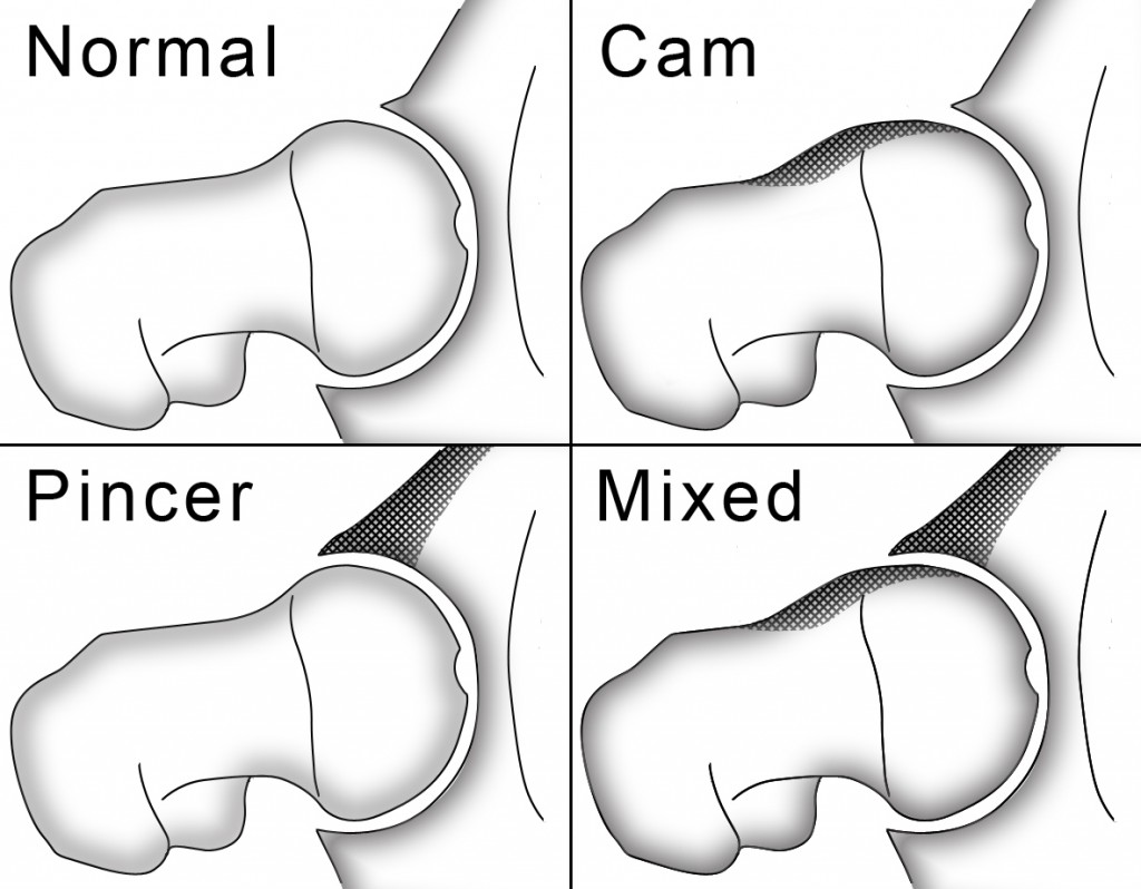 Hockey Training-Femoroacetabular Impingement